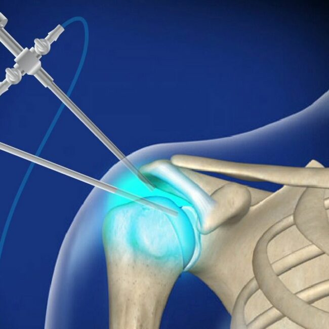 Shoulder Arthroscopy