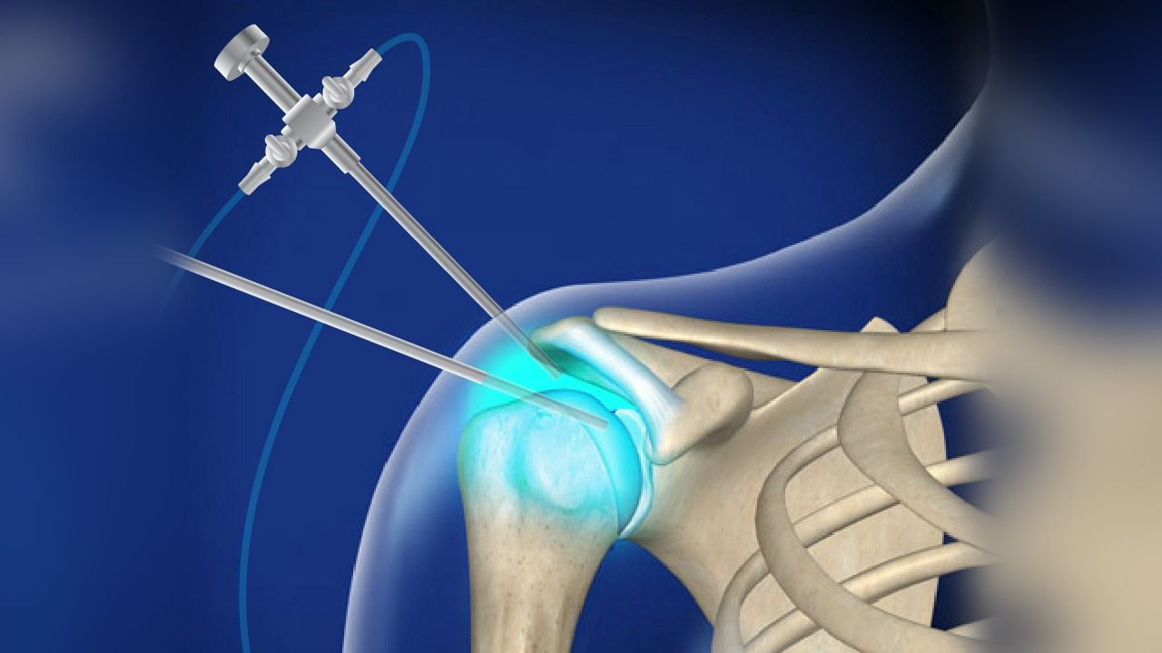 Shoulder Arthroscopy