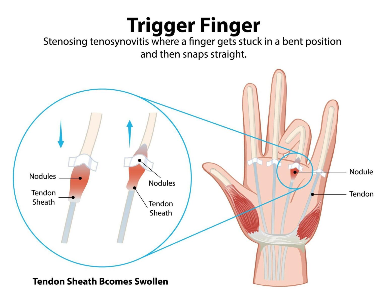 What Is Trigger Finger? - Dr Marouane Bouloudhnine