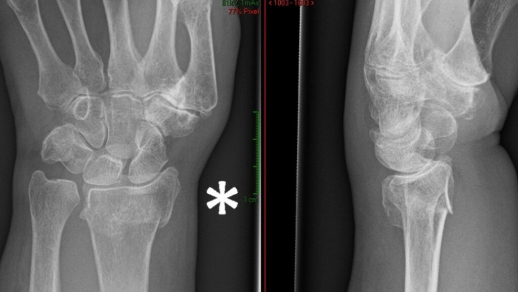 Understanding Radius Fractures: Causes, Symptoms, and Treatment - Dr ...