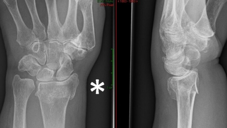 Understanding Radius Fractures: Causes, Symptoms, and Treatment - Dr ...