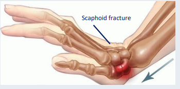 scaphoid fracture