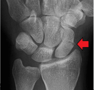 Diagnosis of Scaphoid Fractures