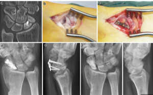 Surgical Treatment