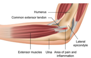 Tennis Elbow