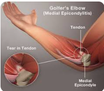 Golfer’s Elbow