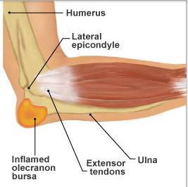 Olecranon Bursitis