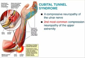 Cubital Tunnel Syndrome