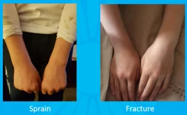 Differentiate Between Sprains and Fractures