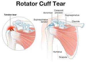 Rotator Cuff Tears