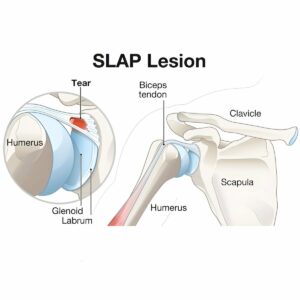 SLAP Tears Superior Labrum Anterior to Posterior Tears