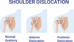 Shoulder Dislocation