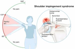 Shoulder Impingement Syndrome