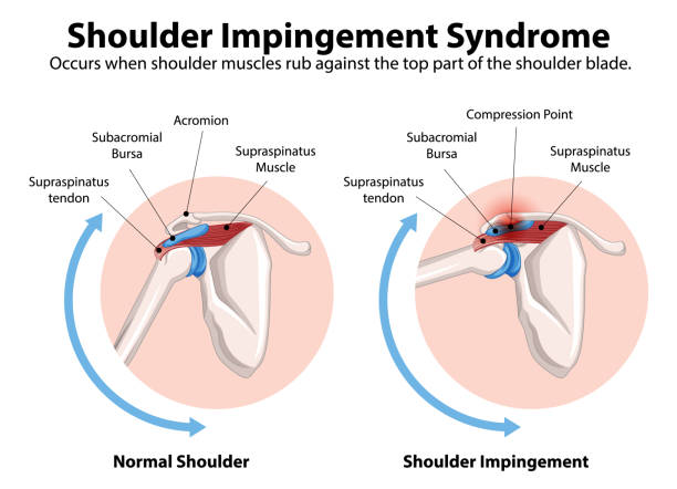 Dubai shoulder specialist Dr Marouane explains how to spot, manage, and treat shoulder impingement before it disrupts your mobility.