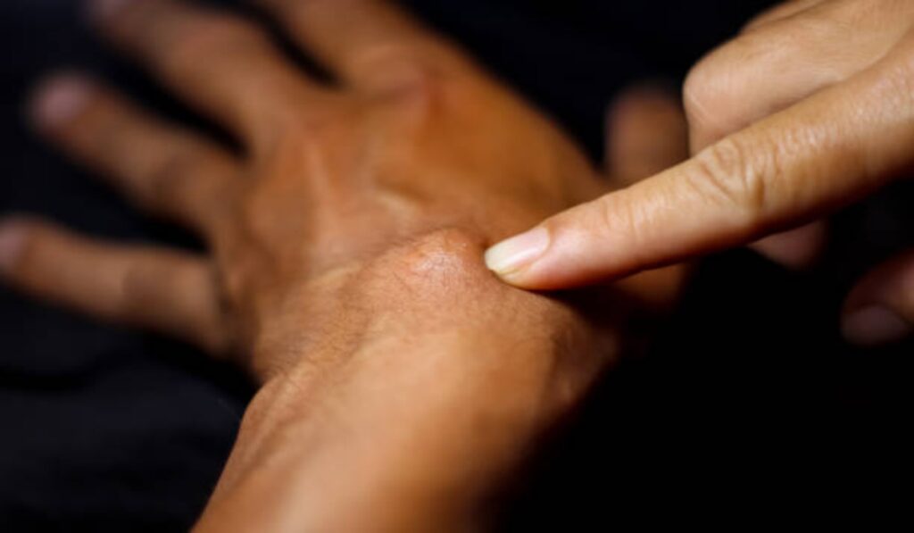 What are ganglion cysts and how are they treated? Dive into their types, causes, diagnosis, and expert-recommended removal methods for lasting relief.