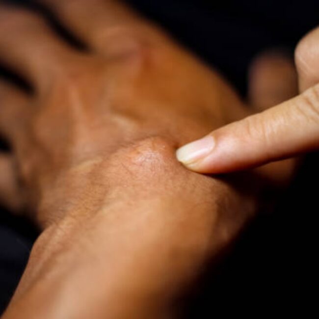What are ganglion cysts and how are they treated? Dive into their types, causes, diagnosis, and expert-recommended removal methods for lasting relief.