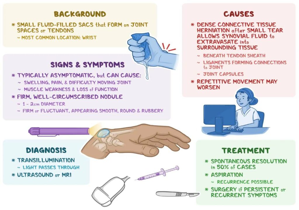 Uncover the mystery of ganglion cysts. This guide explains their types, causes, diagnosis steps, and proven removal techniques to help you take control.