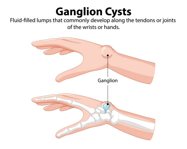 From wrist bumps to treatment plans—get the full scoop on ganglion cysts. Discover causes, diagnosis tips, and removal methods that actually work.
