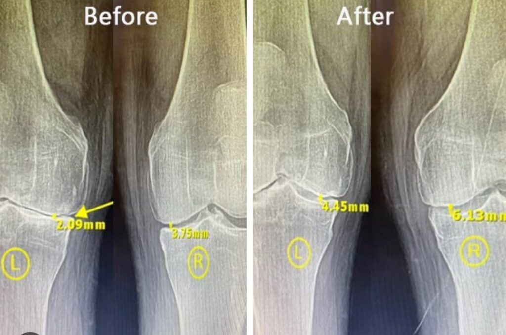 KNEE PAIN ON REGENERATIVE MEDICINE 4 Future of regenerative cartilage reconstruction