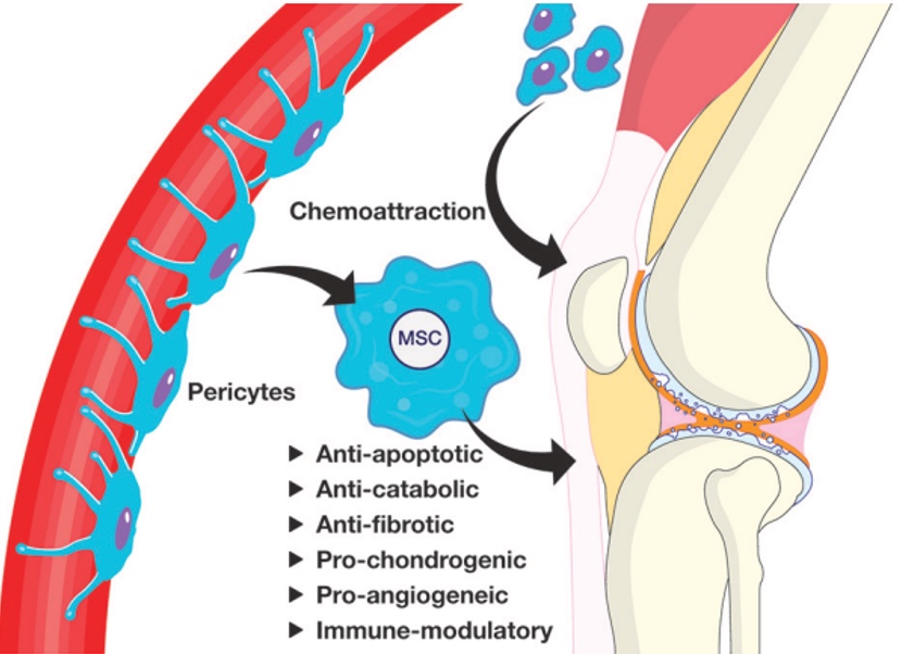 KNEE PAIN ON REGENERATIVE MEDICINE 3 Ultrasound-guided injection of stem cells into the knee joint.