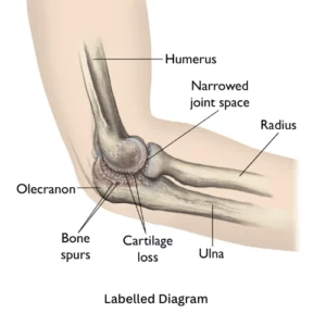 Relieve elbow arthritis pain and restore mobility with regenerative medicine in Dubai. Explore non-surgical solutions with expert Dr. Marouane.