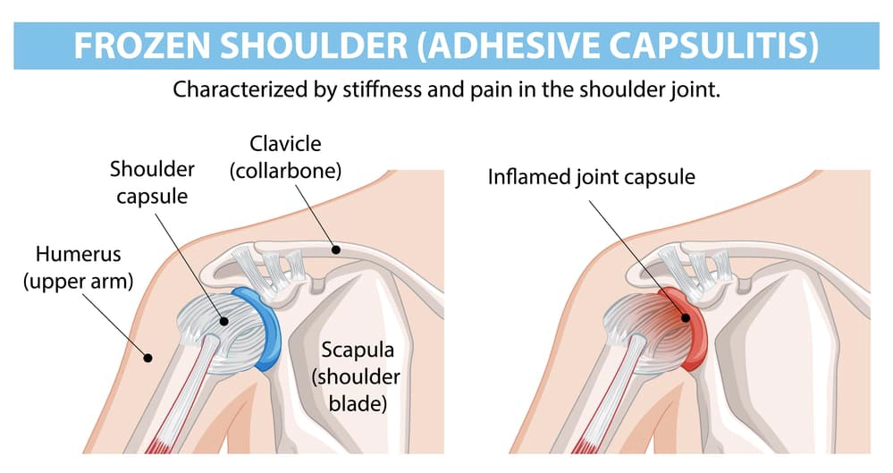 Understanding Frozen Shoulder and Adhesive Capsulitis