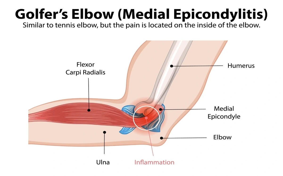Understanding Golfer’s Elbow and Medial Epicondylitis
