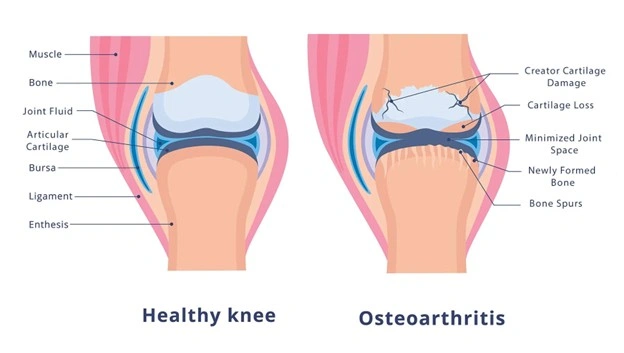 Understanding Knee Osteoarthritis