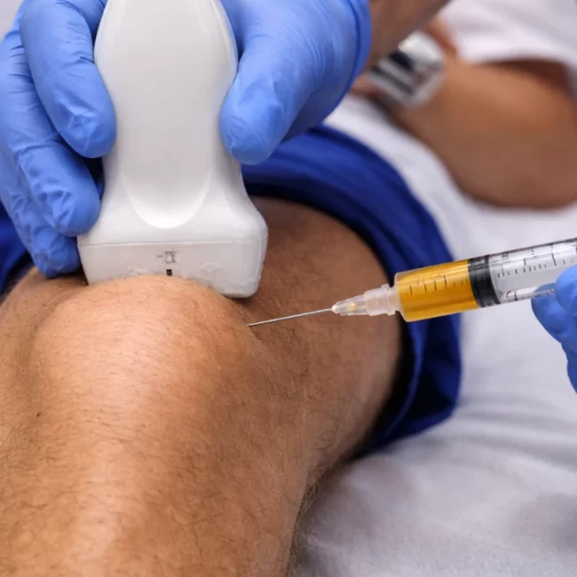 PRP Injections for Knee Osteoarthritis Relief