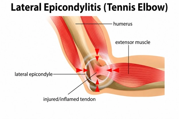 Anatomical illustration of lateral epicondylitis (tennis elbow) showing the inflamed tendon, lateral epicondyle, and forearm extensor muscles.