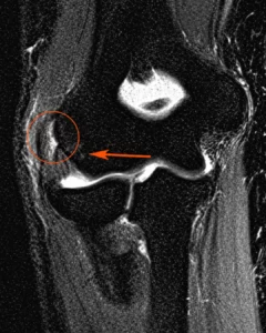 MRI scan highlighting tendon damage associated with lateral epicondylitis (tennis elbow).