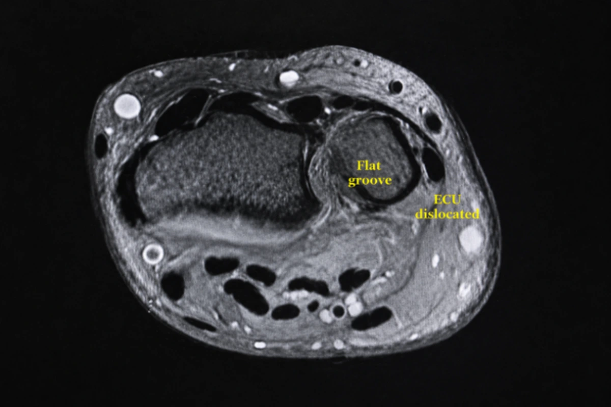 MRI scan showing extensor carpi ulnaris (ECU) tendon subluxation with displacement from the ulnar groove.