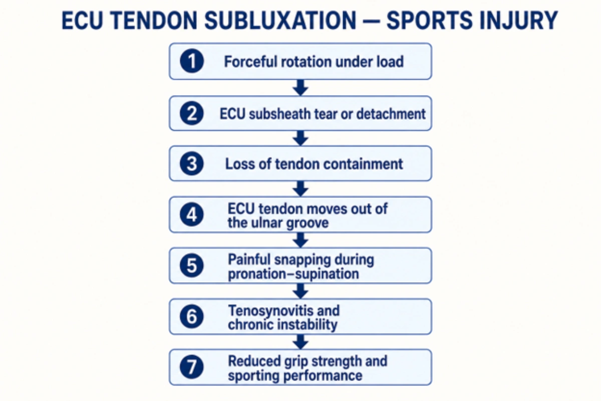 Infographic explaining the progression of ECU tendon subluxation from subsheath tear to chronic wrist instability in athletes.