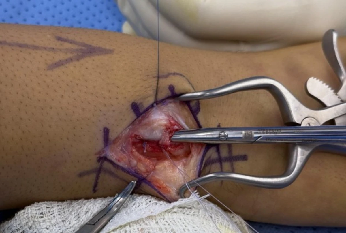 Orthopedic surgeon performing ECU tendon subsheath repair surgery to stabilize extensor carpi ulnaris tendon subluxation.