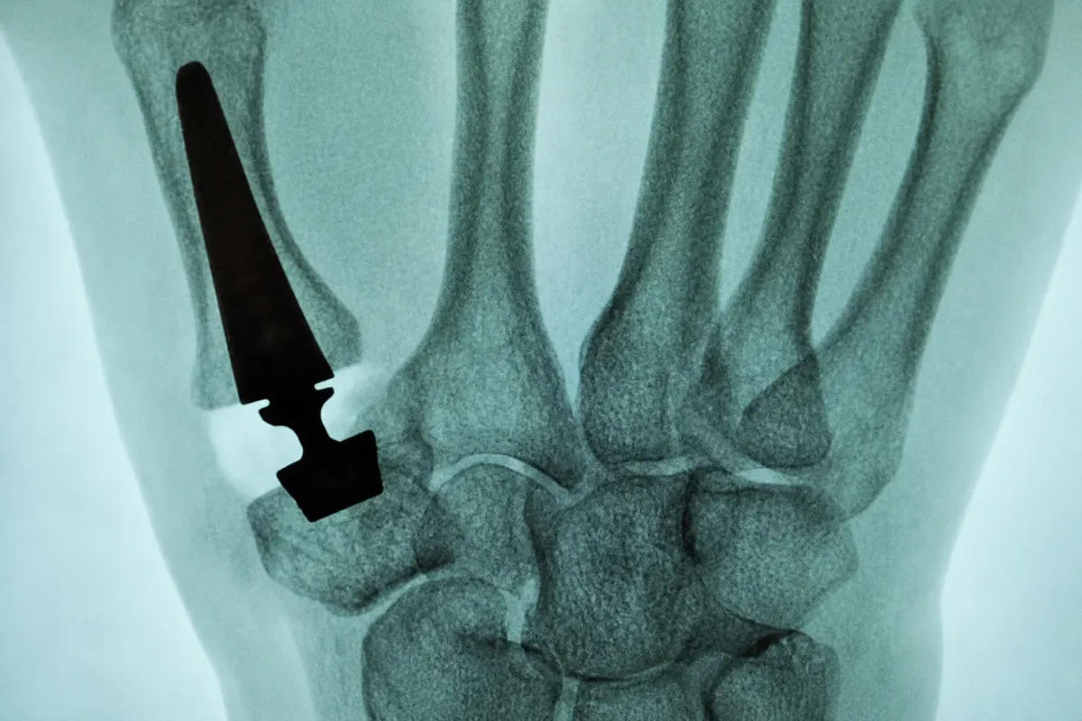 Why Does My Thumb Hurt When I Grip or Open a Jar? 2 X-ray showing a thumb joint replacement implant