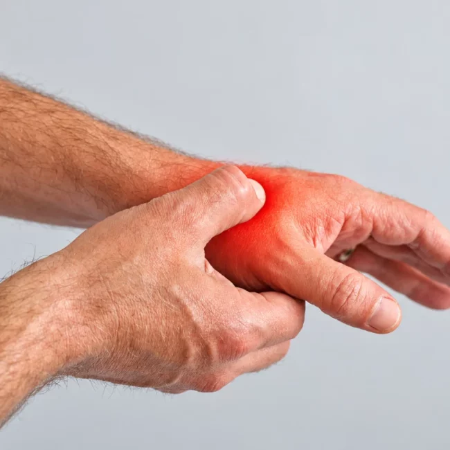 Thumb base arthritis: Person holding the base of the thumb to indicate pain associated with thumb CMC osteoarthritis.